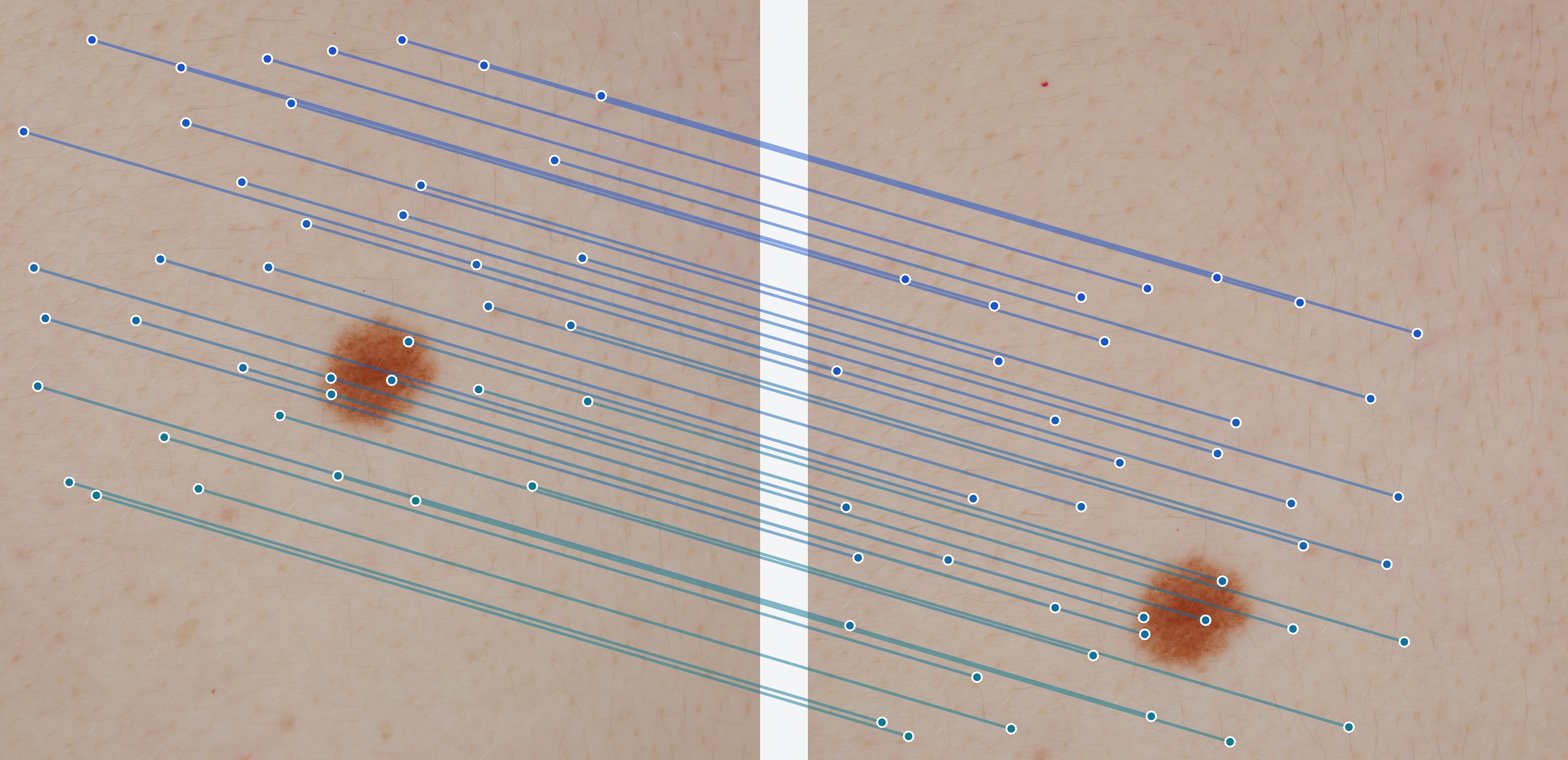 Two square crops of the same skin window from consecutive stations, with 40 matched features joined by thin blue-to-teal lines