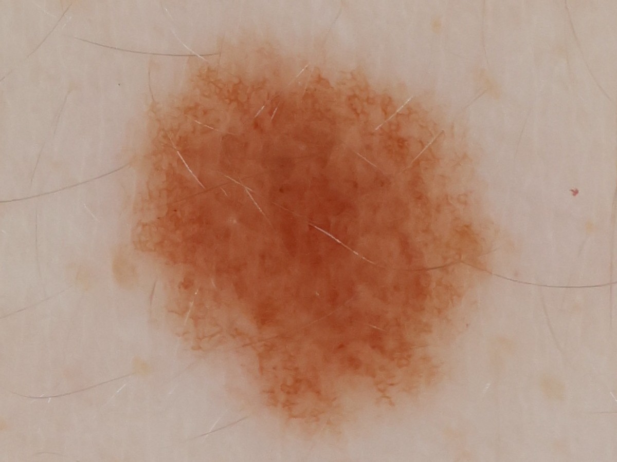 Native-resolution crop of a mole showing its pigment network and individual hairs
