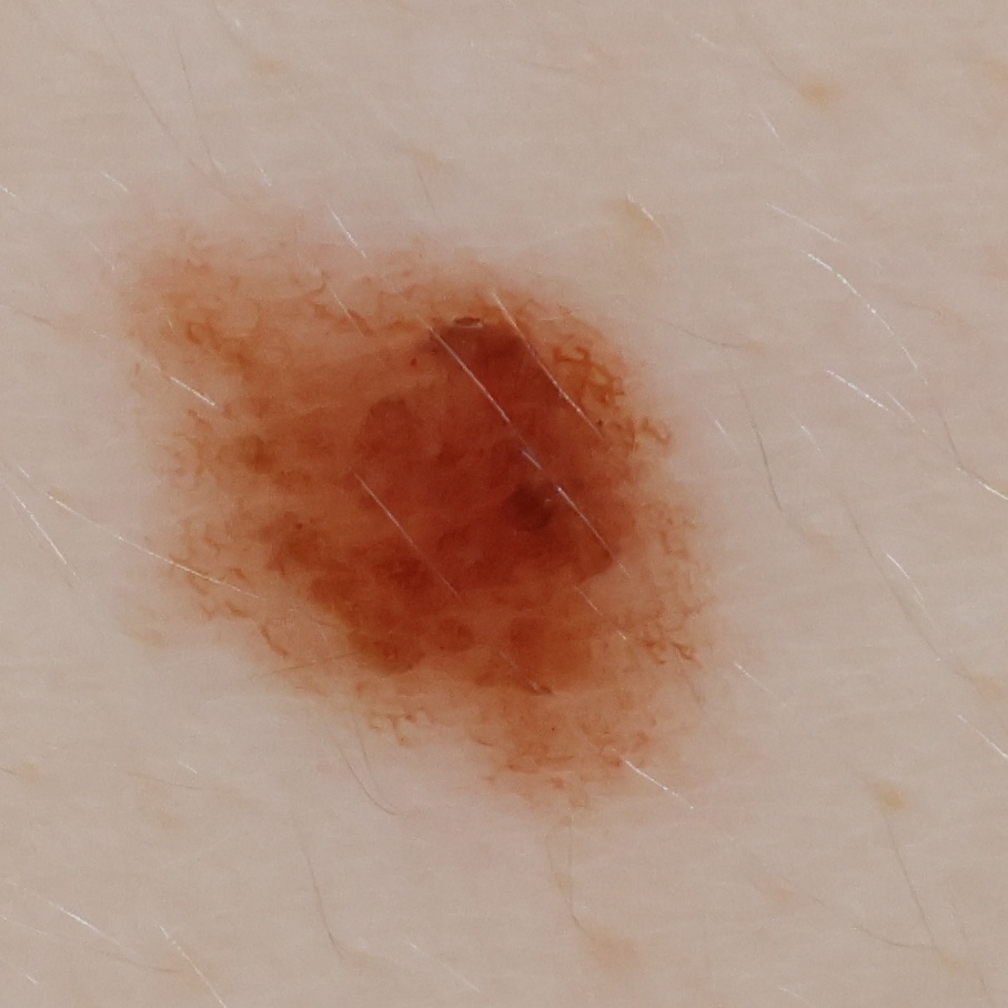 High-resolution crop of a 3.8 mm mole from the scan