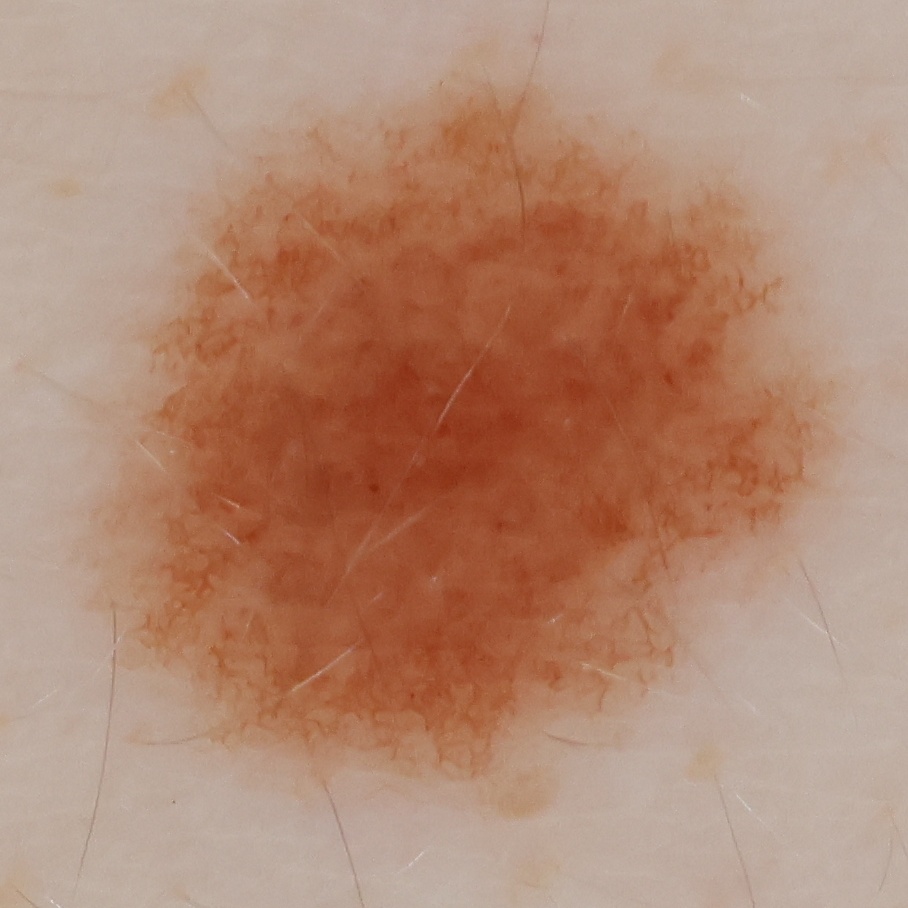 High-resolution crop of a 6.4 mm mole from the scan
