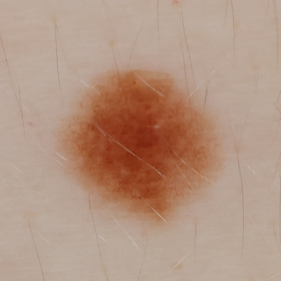 High-resolution crop of a 4.1 mm mole from the scan